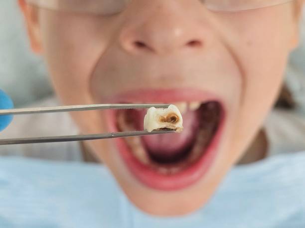 Best Emergency Dental Care for Abscessed Tooth in Diand, MO